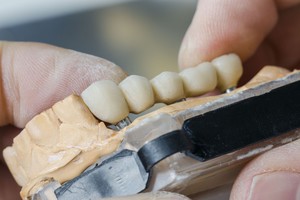 4 dažniausiai užduodami klausimai apie prarastų dantų atkūrimą