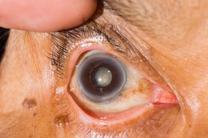 Paaiškino, kaip galite užkirsti kelią apakimui