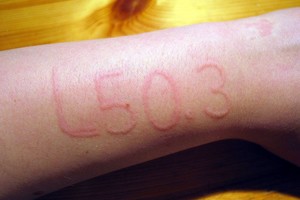 Paslaptinga liga paliečia kas trečią: „Pirštai tampa panašūs į dešreles“