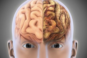 Gelbstint gyvybę svarbiausia laikas: šie požymiai byloja apie insultą