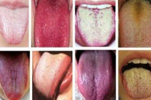 Liežuvio spalva išduoda svarbiausius dalykus apie organizmą