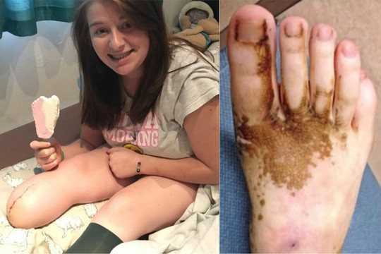 Įaugęs kojos nagas merginai baigėsi tragedija