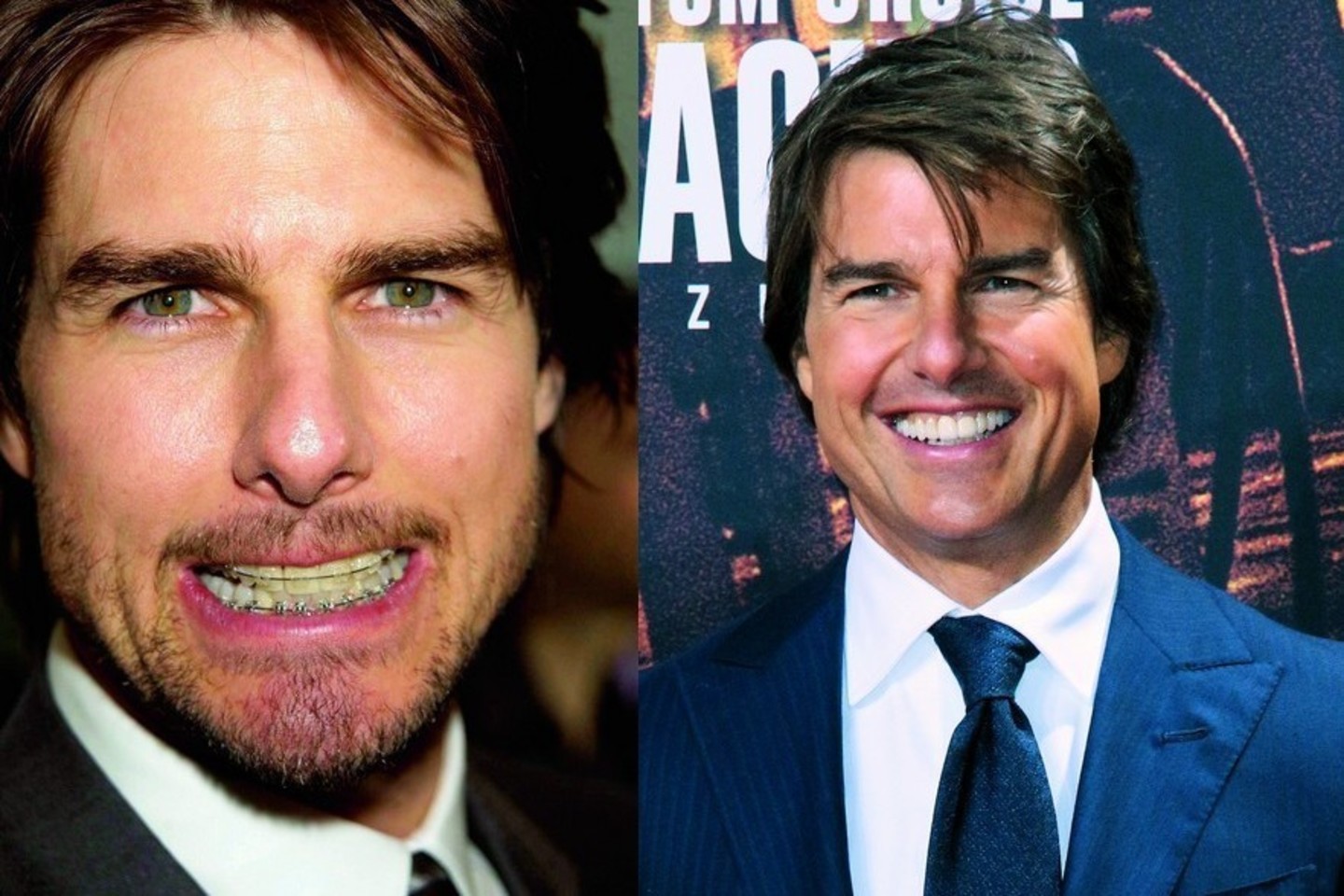 Prisiminus aktorių Tomą Cruise’ą sunku nepagalvoti apie jo akinamą šypseną, tačiau tokią garsus vyras turėjo ne visada. T.Cruise’as susirūpino savo šypsena prieš santuoką su aktore Nicole Kidman.<br>ViDA Press nuotr.