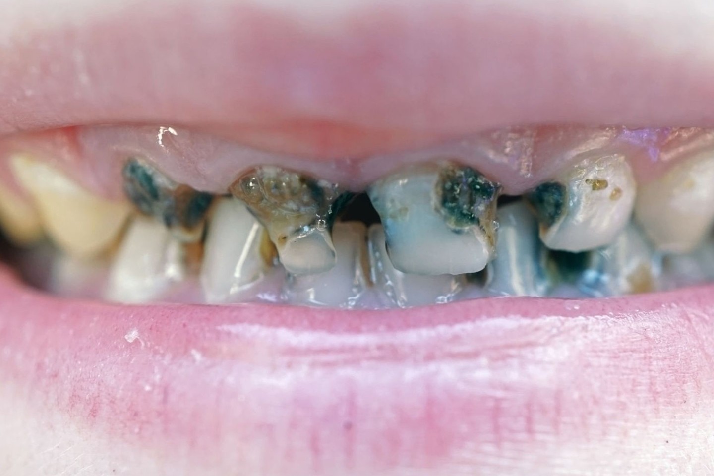 Vos vienerių metų vaikas, o priekiniai dantys jau pažeisti ėduonies, likusios tik šaknys. Dviejų metų vaiko dantys apsinešę ir pajuodę.<br>123rf nuotr.