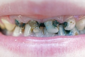 Odontologė įvardijo priežastis, kodėl genda vaikų dantys