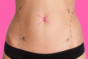 Bambos šalinimas ir kitos plastinės operacijos, kurios nustebins visko girdėjusius