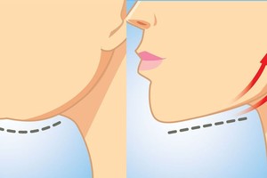 Dangstytis neteks – pasmakrės riebalai išnyks be operacijos