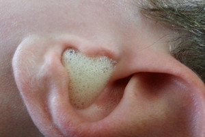 Įsilašino vandenilio peroksido į ausį. Rezultatas patiktų visiems