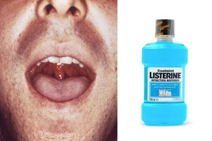 Nustebsite, nuo kokios pavojingos ligos galite išsigelbėti burnos skalavimo skysčiu