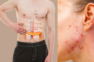 Šie ignoruojami požymiai byloja, kad jūsų žarnynas užterštas toksinais