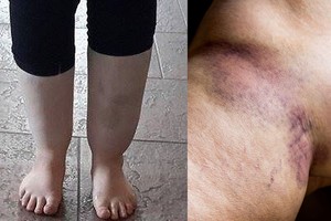 Keli požymiai byloja apie mirtiną kraujo krešulį kraujagyslėje