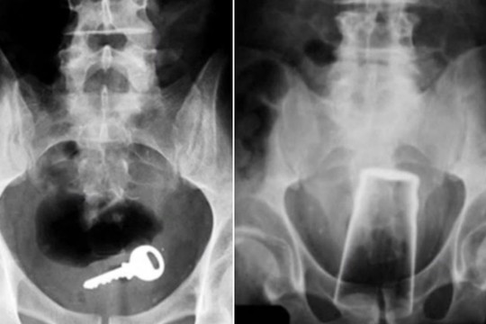 Keisčiausi 2016-aisiais metais kūno ertmėse įstrigę objektai