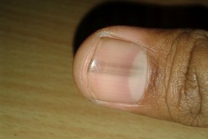 Pasitikrinkite: šie nepastebimi simptomai byloja apie piktybinę ligą