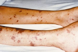 Žaibiška ir mirtina liga užklumpa netikėtai: dažnai supainioja su peršalimu