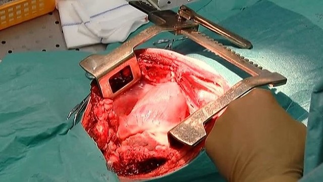 Kauno klinikose – unikalūs eksperimentai su kiaulės širdimi
