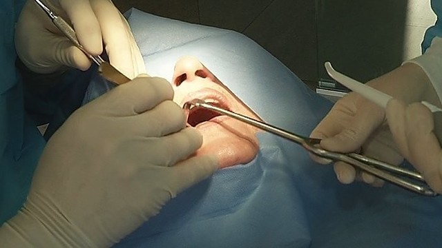 Implantai ar dantų plokštelė – kas geriau? (I)