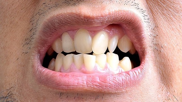 Ką svarbu įvertinti kiekvienam prieš dantų implantaciją