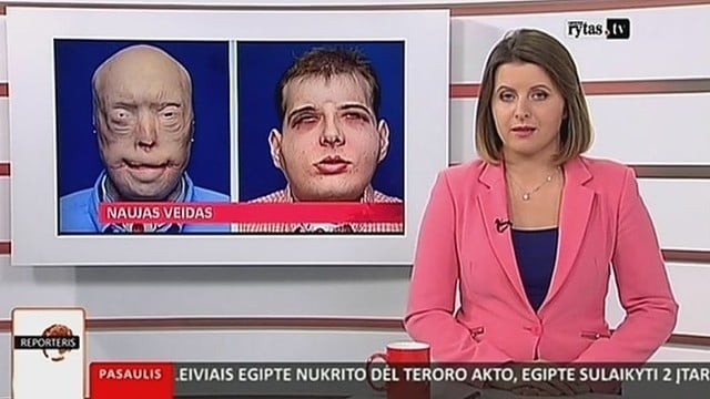 Niujorke atlikta unikali veido persodinimo operacija (II)