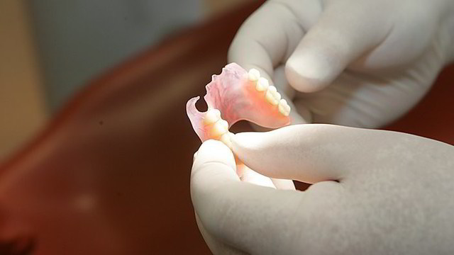 Pacientus pribloškė nauja dantų protezavimo tvarka