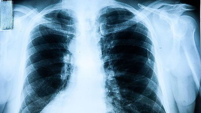 Plinta pavojinga plaučių liga, kuri gali baigtis mirtimi