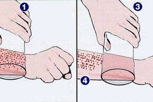 Pridėkite stiklinę prie odos – tai gali išgelbėti jums gyvybę