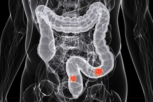 5 dažnai nepastebimi simptomai, įspėjantys apie pražūtingą ligą