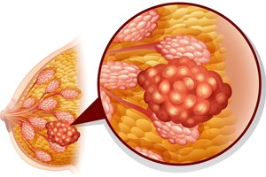Daugelis moterų nepasinaudoja joms suteikta proga ir kraupią diagnozę sužino per vėlai