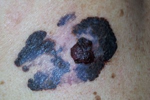 Medikai dėl odos vėžio kviečia konsultuotis internetu