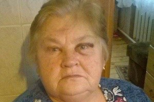 Į klinikas išvyko tirtis plaučių, o grįžo su mėlynėmis po akimis