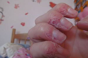 Nagų odelių kramtymas gali baigtis net tragiškai, bet yra paprastas būdas to atsikratyti