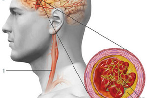 Sužinoję tai, kraujospūdį sumažinsite natūraliai ir išvengsite insulto