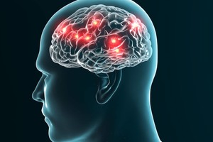 11 paprastų gydytojo patarimų, kaip sumažinti insulto riziką