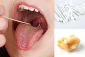 Nemalonaus kvapo priežastis slypi jūsų gerklėje – štai ką turite žinoti