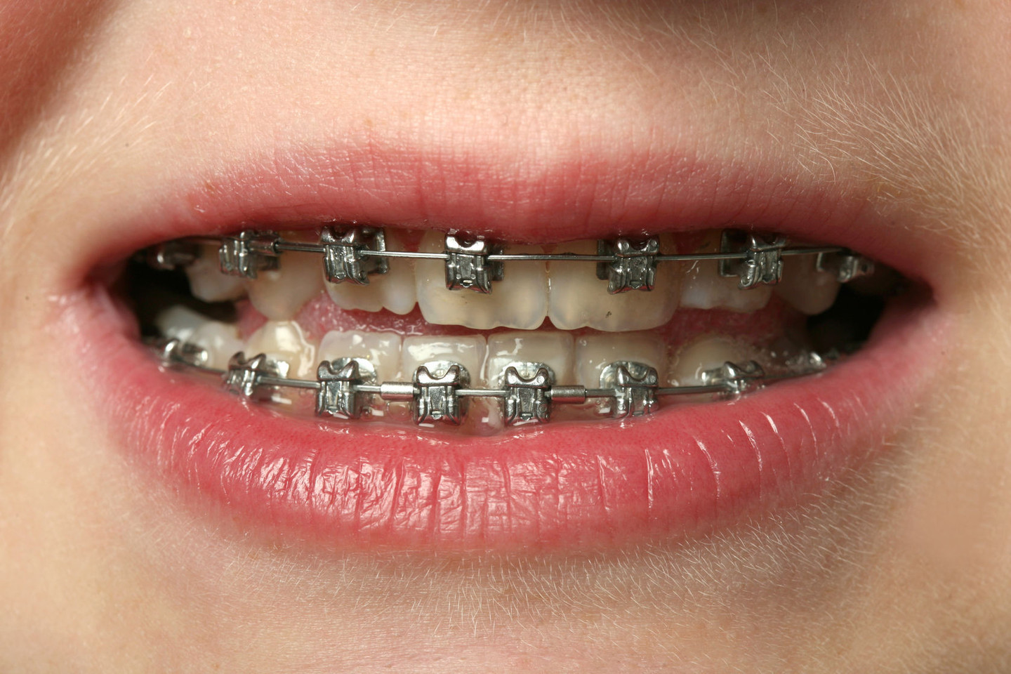 Breketai tvirtinami ant dantų siekiant juos sulyginti.<br>123rf nuotr.
