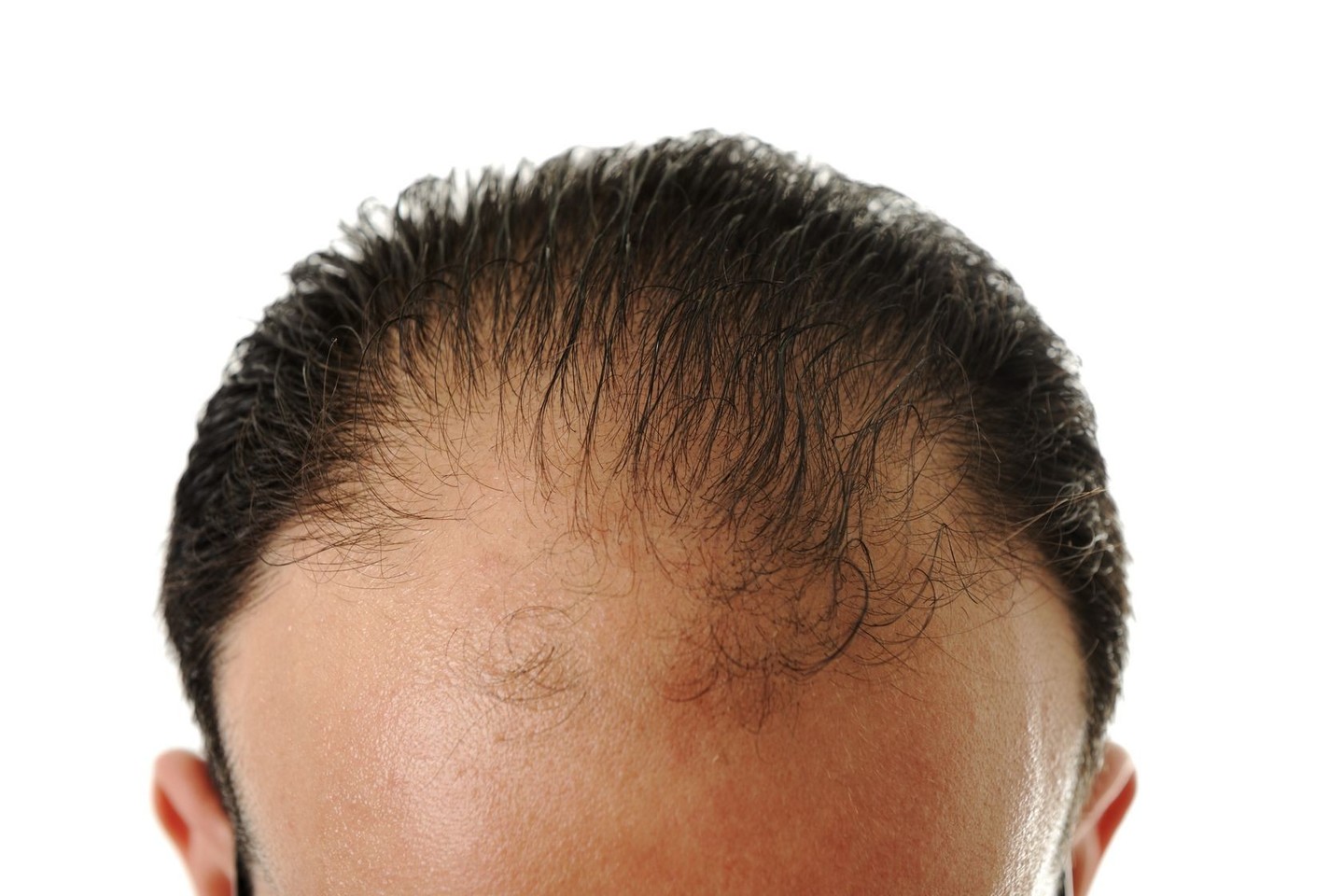 Plaukų slinkimas – daugelį žmonių kamuojanti problema, kuriai išgydyti vien liaudies priemonių gali ir nepakakti.<br>123rf.com