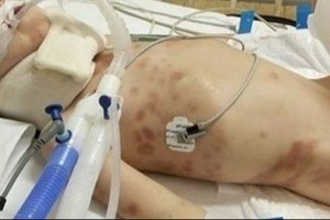 Atskleidė Kauno klinikose mirusio penkiamečio iš Vilkaviškio mirties priežastį