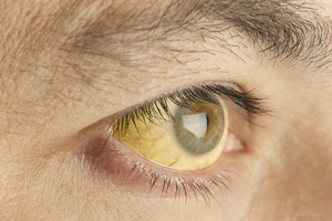 Perspėjimas: siaubinga liga galite susirgti to net nežinodami