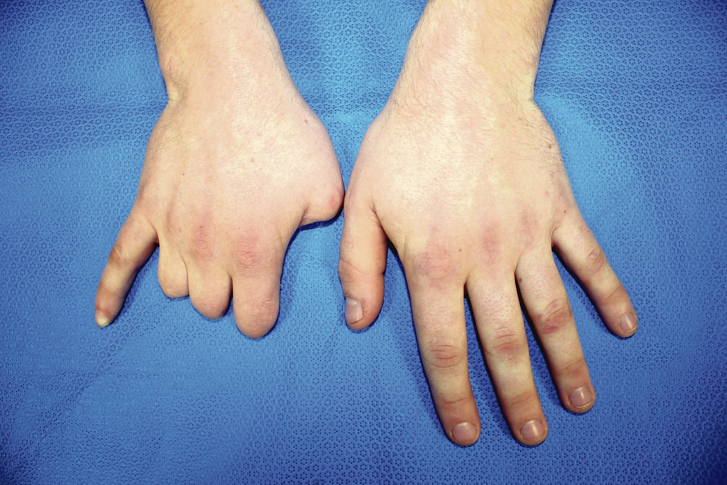 Praradus rankos nykštį dažniausiai chirurgai siūlo persodinti kojos nykštį.