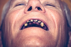 Kai kuriems senjorams sužibo viltis – dantis sutaisys nemokamai