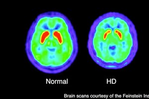 Visų organizme slypi grėsmingos ligos priežastis, bet suserga ne visi