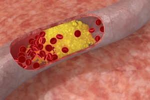 5 dalykai, kurių niekas nepasako apie jūsų cholesterolį