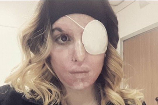 Pavydaus vaikino rūgštimi nudeginta gražuolė išdrįso parodyti veidą