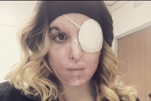 Pavydaus vaikino rūgštimi nudeginta gražuolė išdrįso parodyti veidą