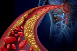Privalote žinoti savo cholesterolio normą ir kaip pašalinti perteklių