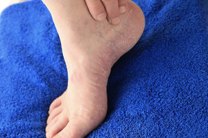 4 liaudiški metodai nuo pėdų grybelio - ką turite apie juos žinoti