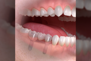 Svarstote apie dantų implantus? Štai ką turėtumėte įvertinti