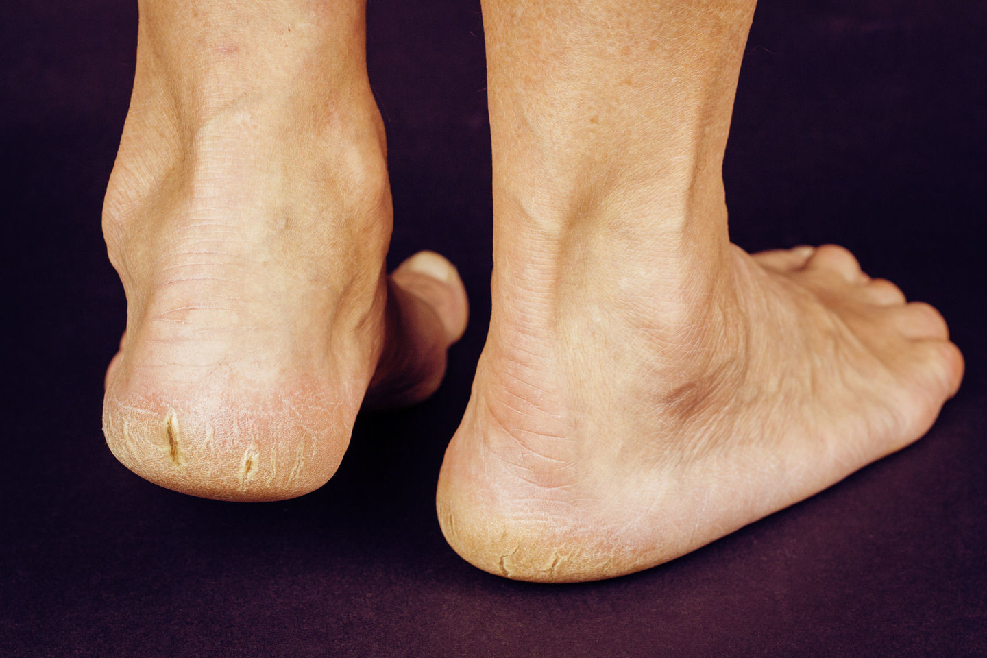  Tinkamai neprižiūrima pėdų oda tampa lengviau pažeidžiama grybelinės infekcijos.<br> 123rf.com nuotr.
