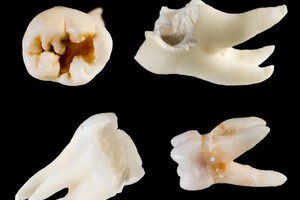 Neįtikėtina: dantyse slypinti medžiaga gali išgelbėti kone svarbiausią žmogaus jutimą