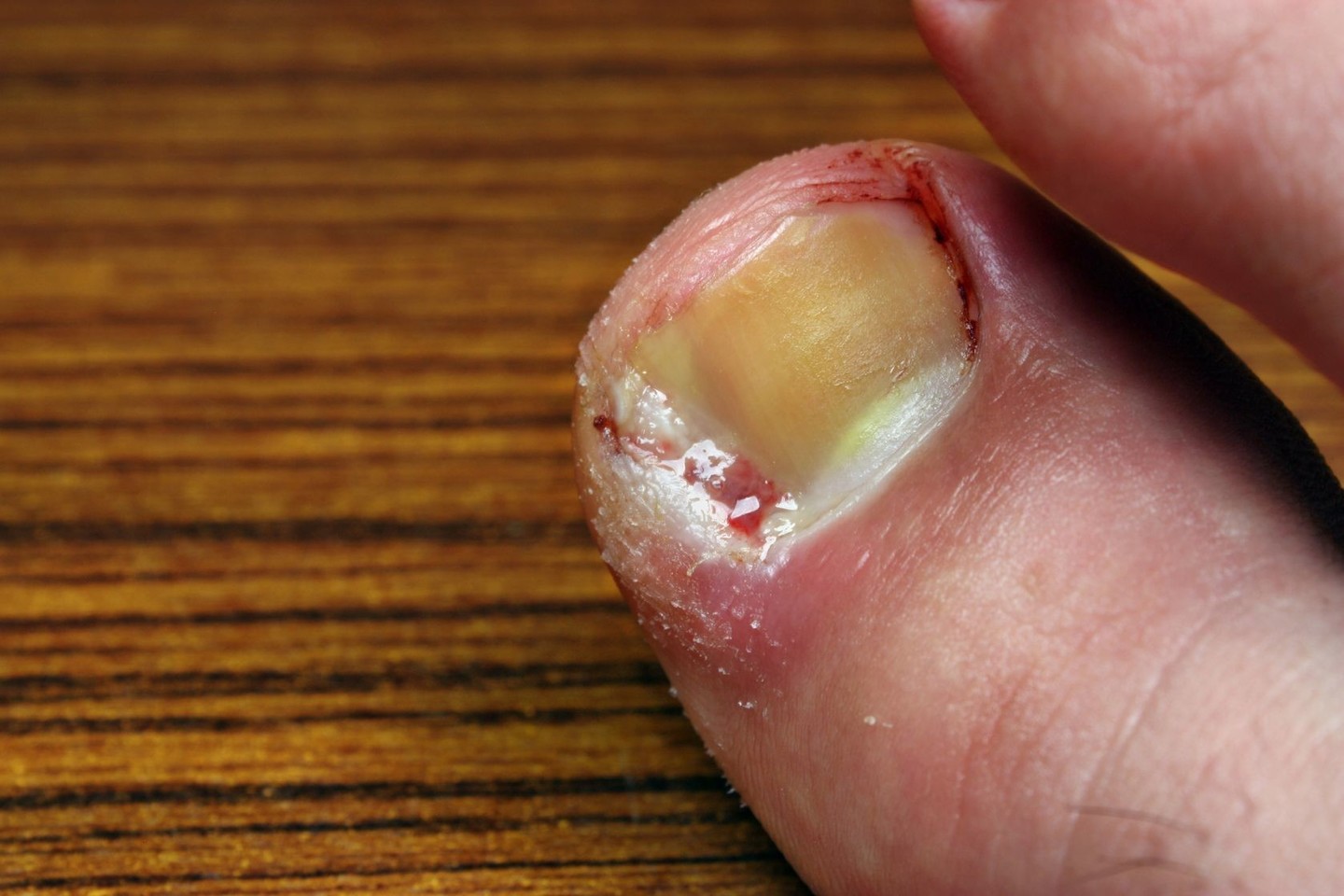 Negydomas įaugęs pėdos nagas gali sukelti rimtų problemų.<br> 123rf.com nuotr.