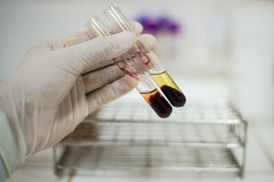 Nulemta likimo – jūsų kraujo grupė diktuoja, kokiomis ligomis sirgsite